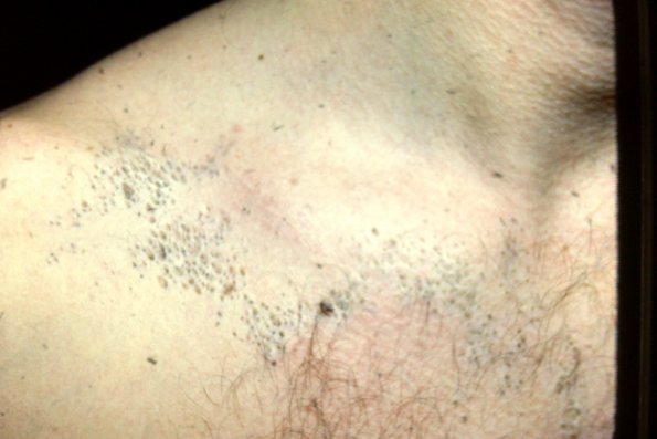 Nevus Comedonicus (4)