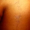 Nevus Comedonicus (9)