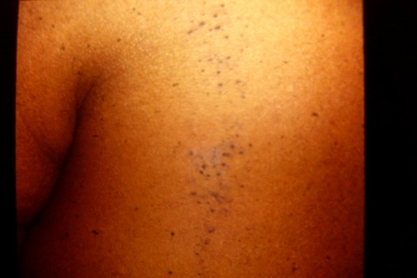 Nevus Comedonicus (9)