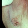 Nevus Sebaceous (2)