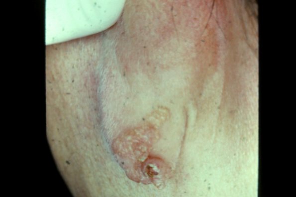 Nevus Sebaceous (2)