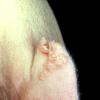 Nevus Sebaceous