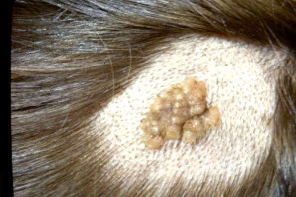 Nevus sebaceous Organoid Nevus