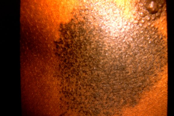 Nevus Spilus 5