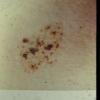 Nevus Spilus Speckled Lentignous