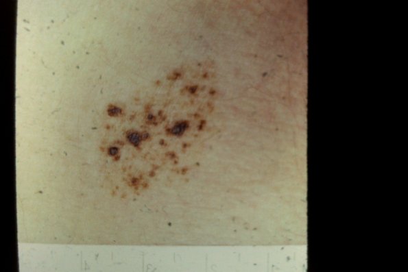 Nevus Spilus Speckled Lentignous