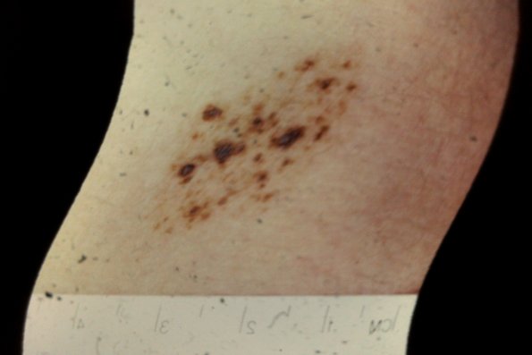 Nevus Spilus