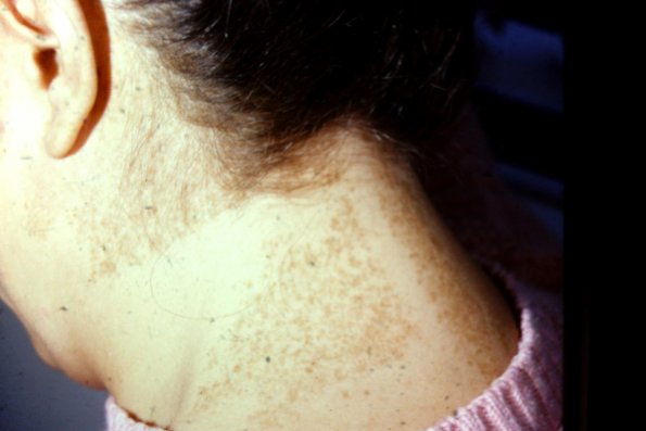 Speckled Lentighams Nevus