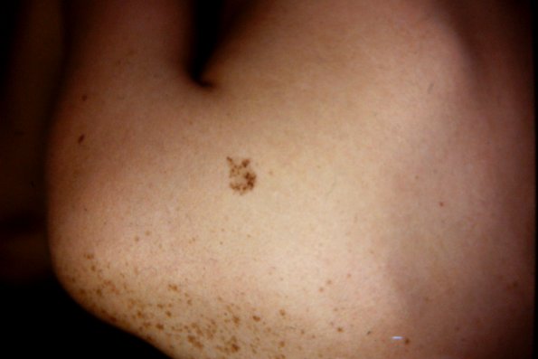 Speckled Lentigirous Nevus