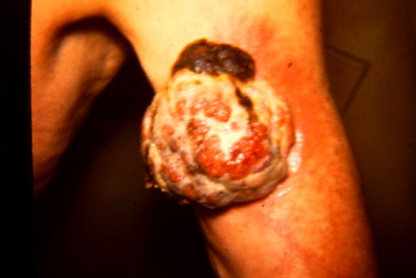 Nodular Melig Melanoma