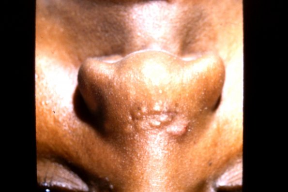 Nodular Sebaceus Hyperplasma