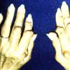 Rheumatoid Nodules