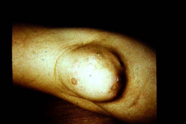 Rheumatoid Nodule (2)