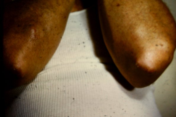 Rheumatoid Nodule (7)