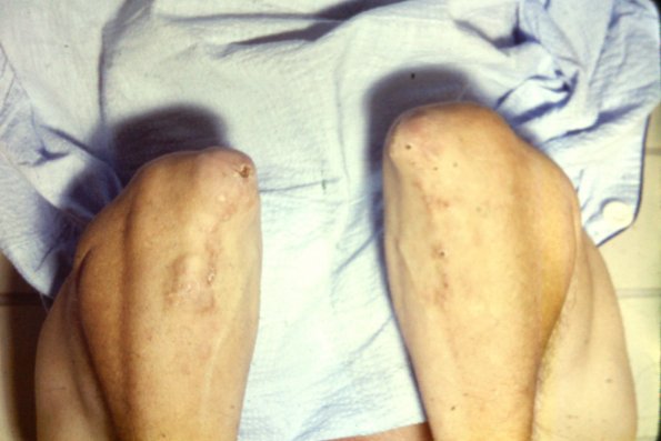 Rheumatoid Nodules + Granuloma Annulare