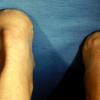 Painful Piezogenic Papules Heels