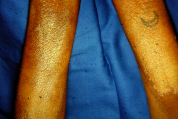 Pellagra (3) | Pellagra | Comprehensive Dermatology Photo Atlas | Wayne ...