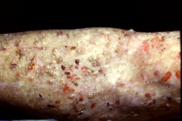 Bullous Pemphigoid (2)