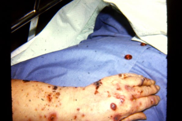 Bullous Pemphigoid (3)