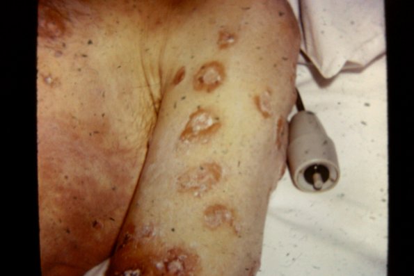 Bullous Pemphigoid (9)