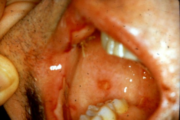 Paraneoplastic Pemphigus (2)