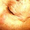 Pemphigoid (2)