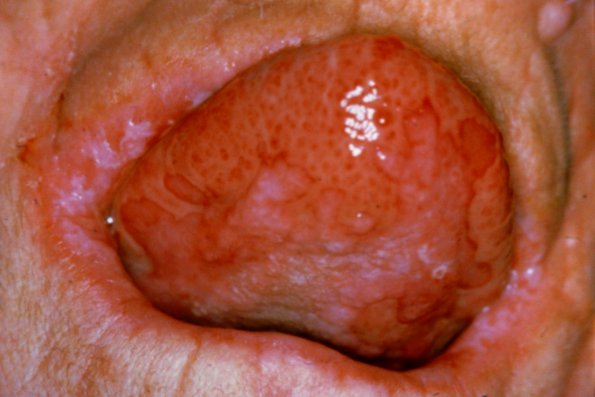 Pemphigus Erythematous