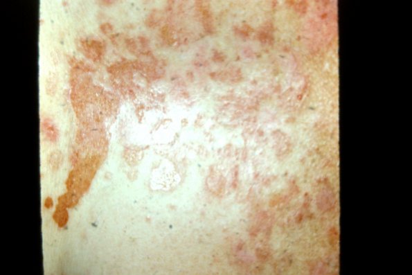 Pemphigus Foliaceus (3)