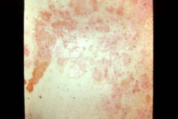 Pemphigus Foliaceus (4)