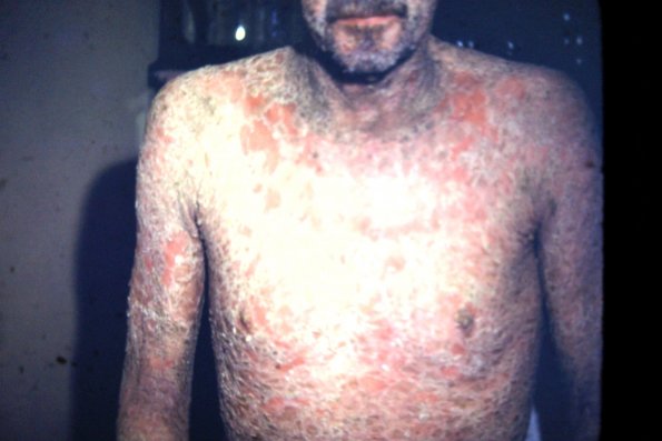 Pemphigus Folicaceus (3)