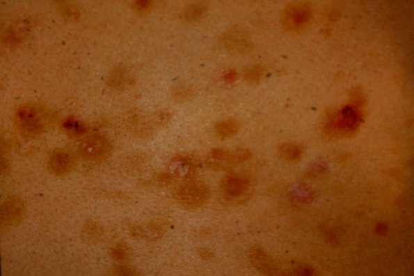 Pemphigus Folliaceus (3)