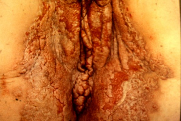 Pemphigus Vegetous (2)