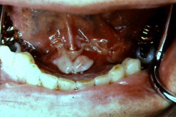 Pemphigus Vulgaris (14)