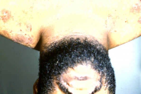 Pemphigus Vulgaris (2)