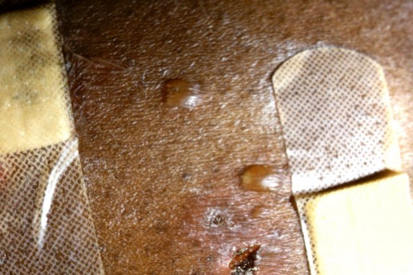 Pemphigus Vulgaris (5)