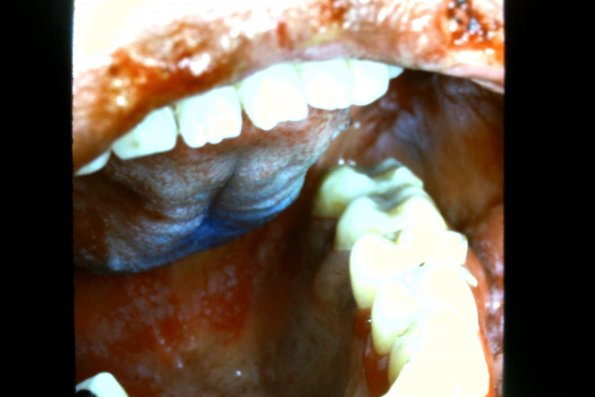 Pemphigus Vulgaris (6)