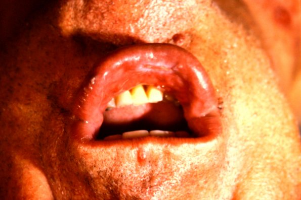 Pemphigus Vulgaris (7)