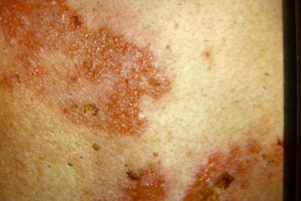 Pemphigus of Back