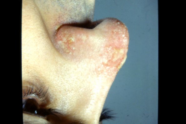 Permphigus Caragozlo