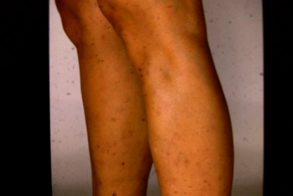 Cutaneous Periarteritis Nodosa