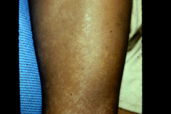 Actinic Porokeratosis