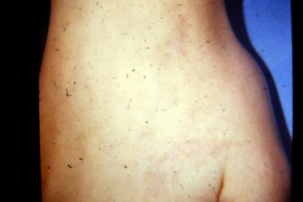 Linear Prokeratosis (3)