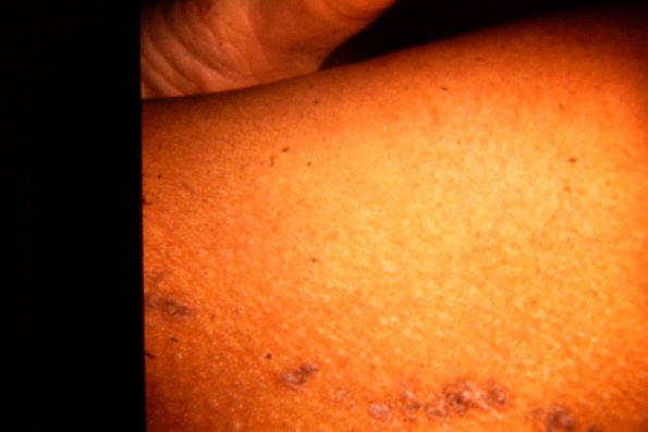 Linear Prokeratosis