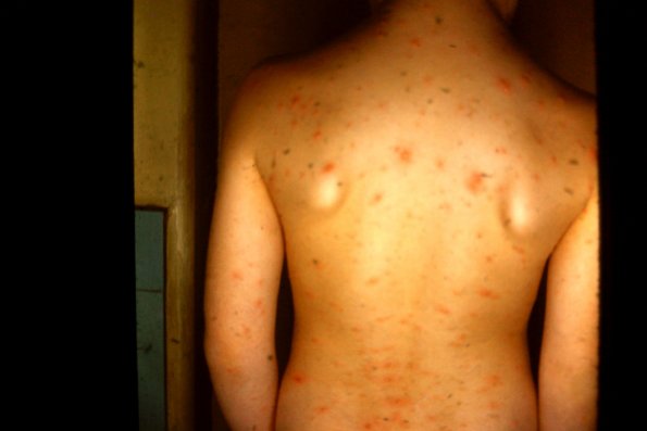 Chicken Pox (7)