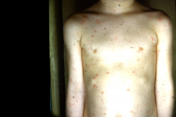 Chicken Pox (8)