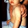 Chicken Pox After Vaccination