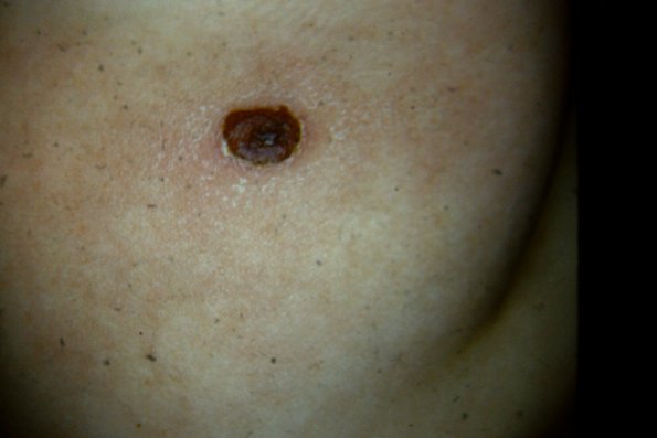Smallpox Vaccination (2)