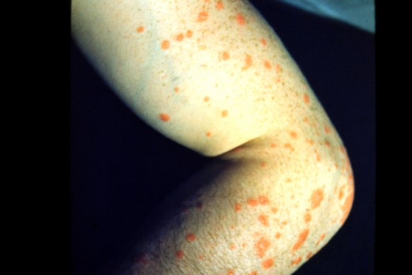 Guttate Psoriasis (14)