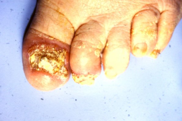 Nail Psoriasis (59)