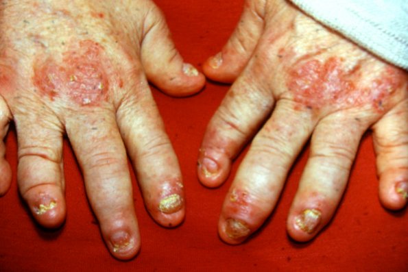 Psoriasis (57)